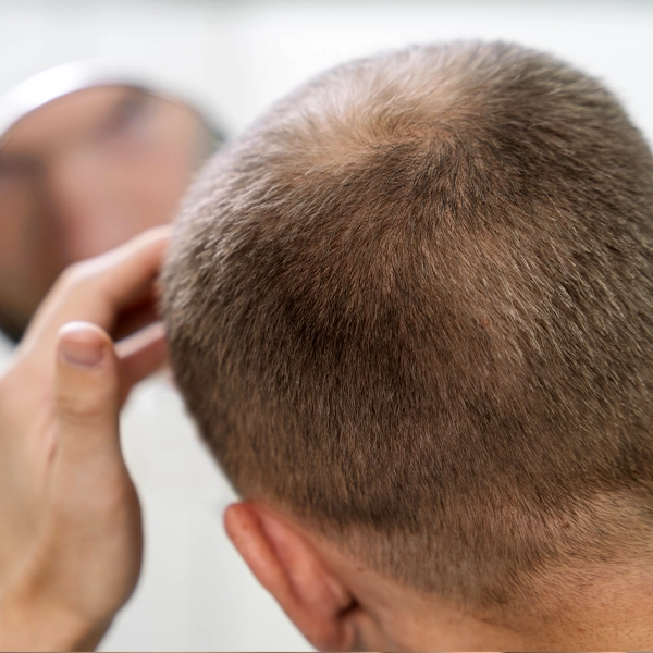 Caduta dei capelli come contrastare le calvizie