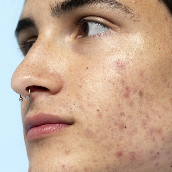 Acne cause e rimedi: tutti i falsi miti